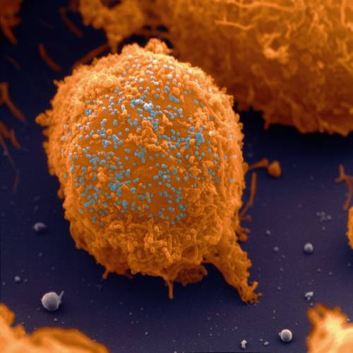 Barevný snímek viru HIV na povrchu T-lymfocytu, bílé krvinky (žlutohnědý hrudkovitý povrch s nepravidelnými výstupky), infikované virem (kulovité modré útvary) HIV (Human Immunodeficiency Virus). 