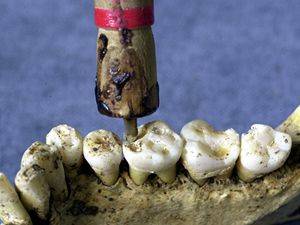 V Pákistánu se zuby vrtaly už před 9000 lety.
