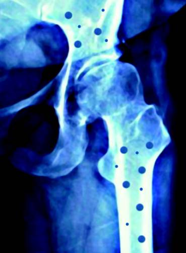Každému z nás se za život obnoví v těle všechny kosti. Dokonce několikrát! Bohužel, hlavně s přibývajícími roky kosti tuto schopnost zvolna ztrácejí a začnou se lámat i při malých nárazech či pádech. Lze předpokládat, že zdravotním a sociálním problémem 21. století bude tichá „epidemie“ osteoporózy – řídnutí kostí.