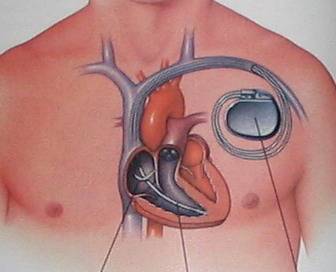 Špatný srdeční rytmus dokáže v srdci a potažmo celém organismu napáchat výrazné škody a může vést až k infarktu. Američtí vědci proto zkoumají procesy v tkáni srdečního svalu a  snaží se nalézt cesty, které by mohly napomoci  problematické rytmy zkrotit.