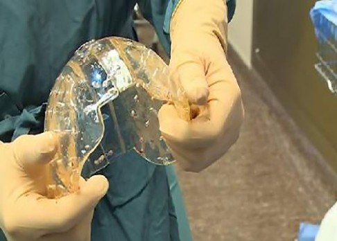 Lékaři transplantovali lebku z 3D tiskárny